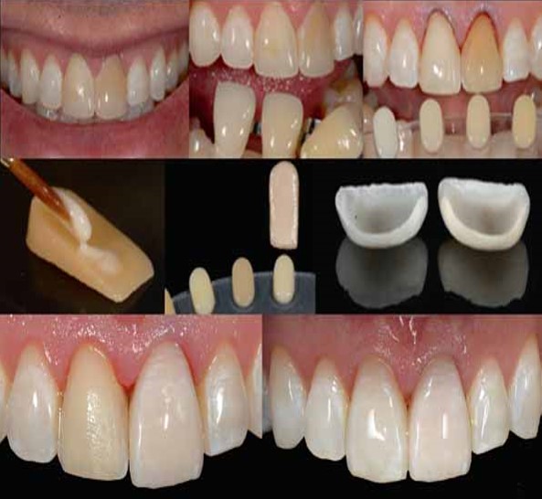 RDA Study Materials - Restorative and Esthetic Dentistry